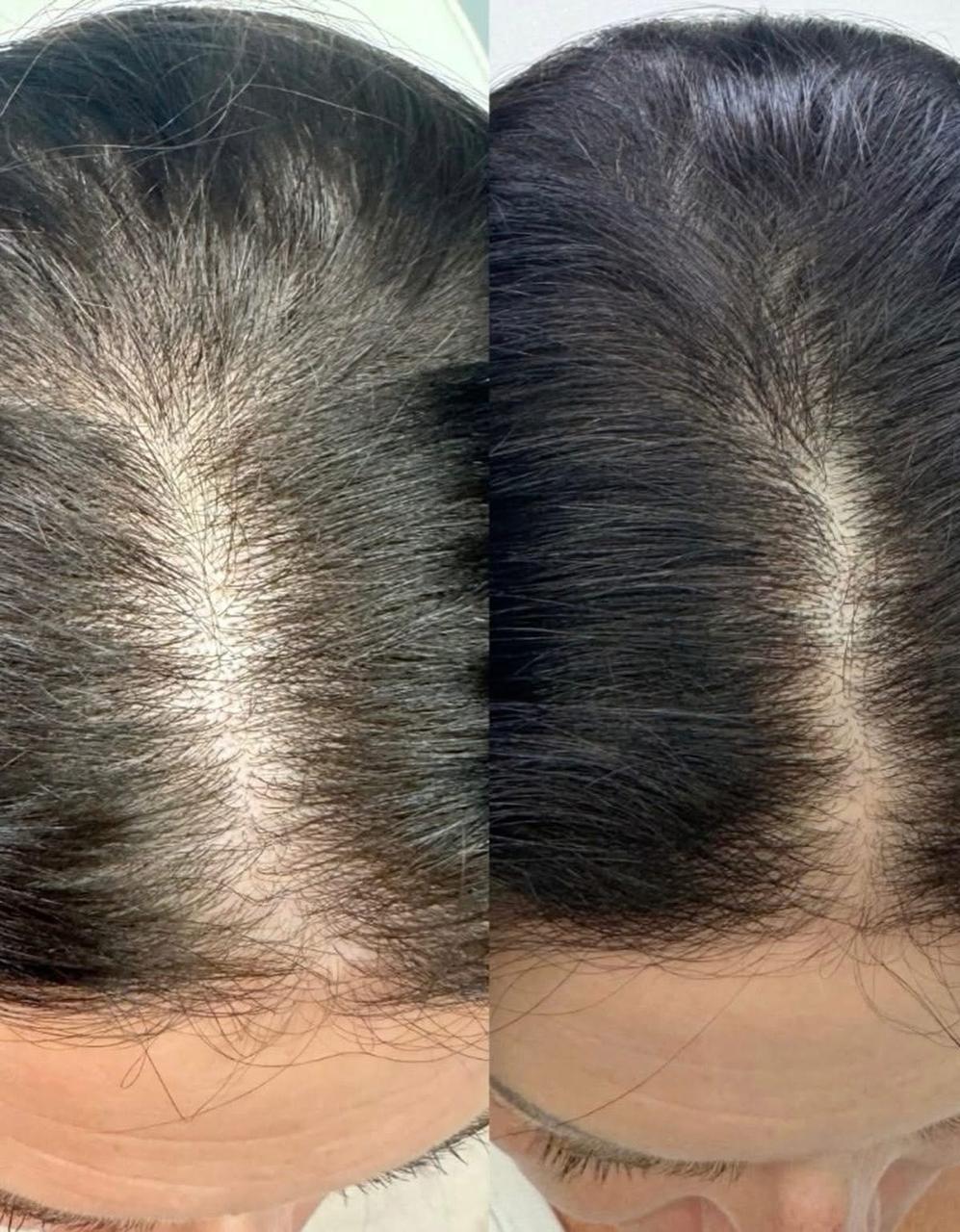 Kit de Crecimiento Capilar